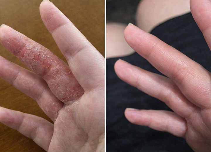 A before-and-after comparison of a finger with red, flaky skin, next to the same finger looking smooth.