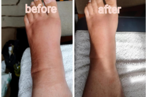 A before and after photo showing a swollen foot on the left and the same foot with reduced swelling on the right.