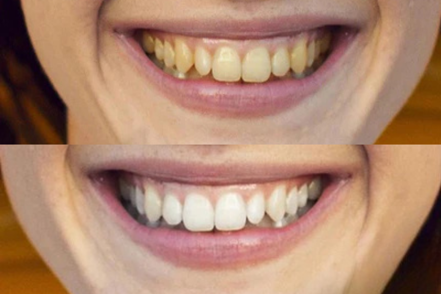 Before and after image of teeth whitening.