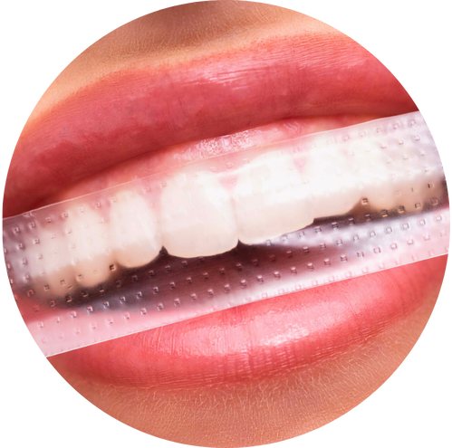 Close-up of a mouth with a teeth whitening strip applied.