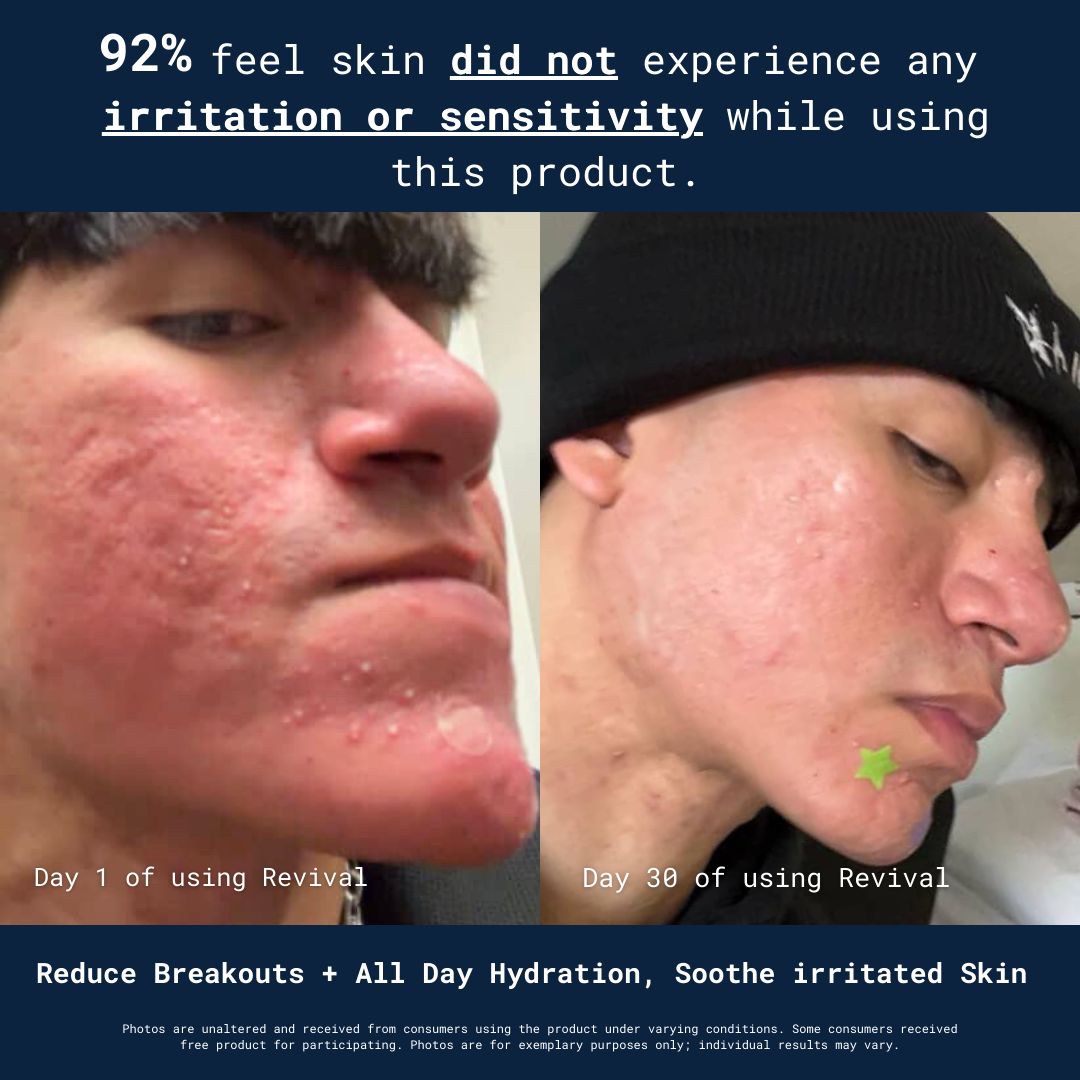 Before-and-after images of skin improvement after using a product for 30 days.