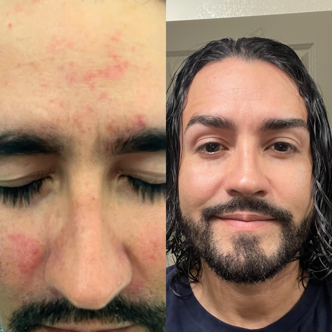 Side-by-side comparison of a man's face with and without skin redness.