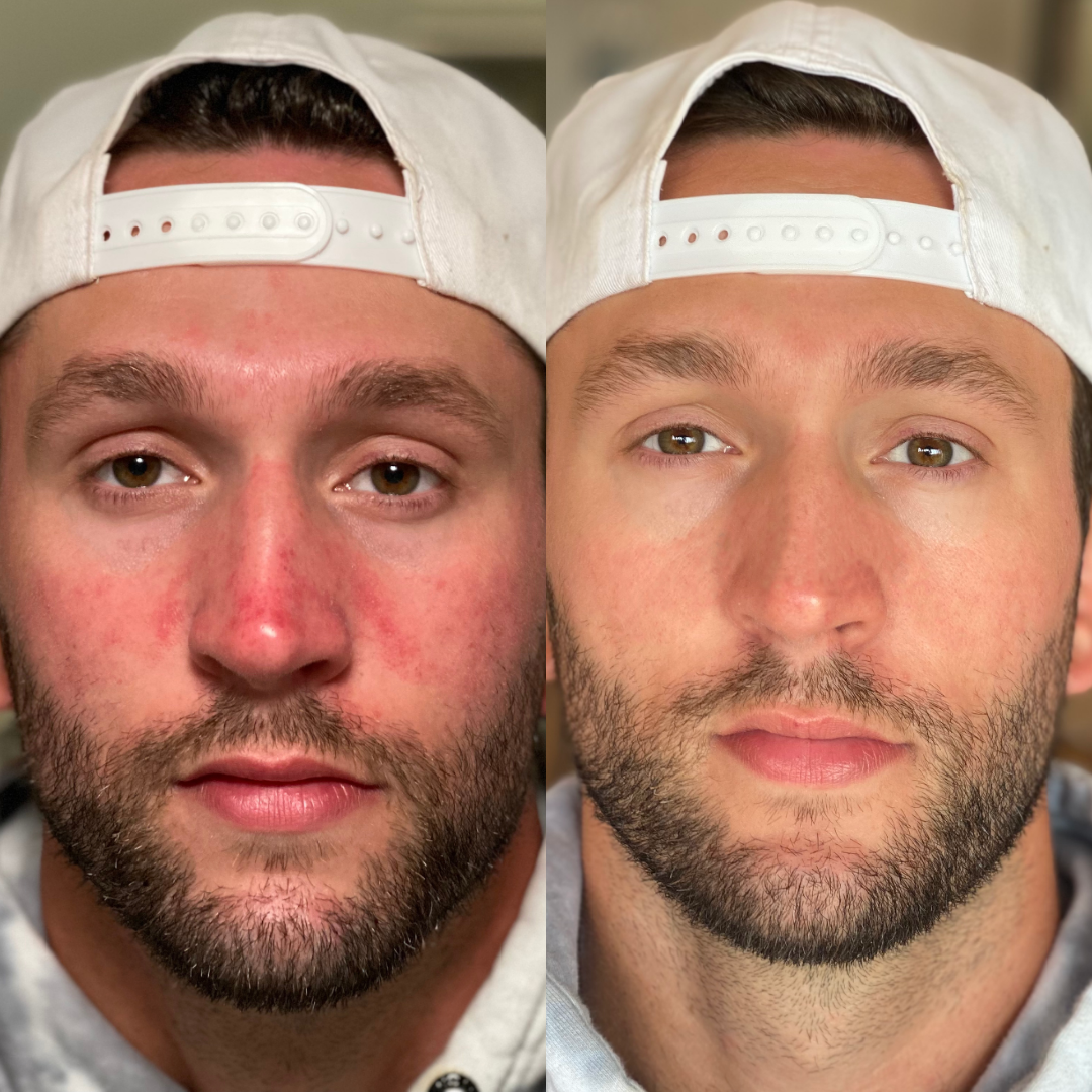 Side-by-side comparison of a man's face with and without redness.
