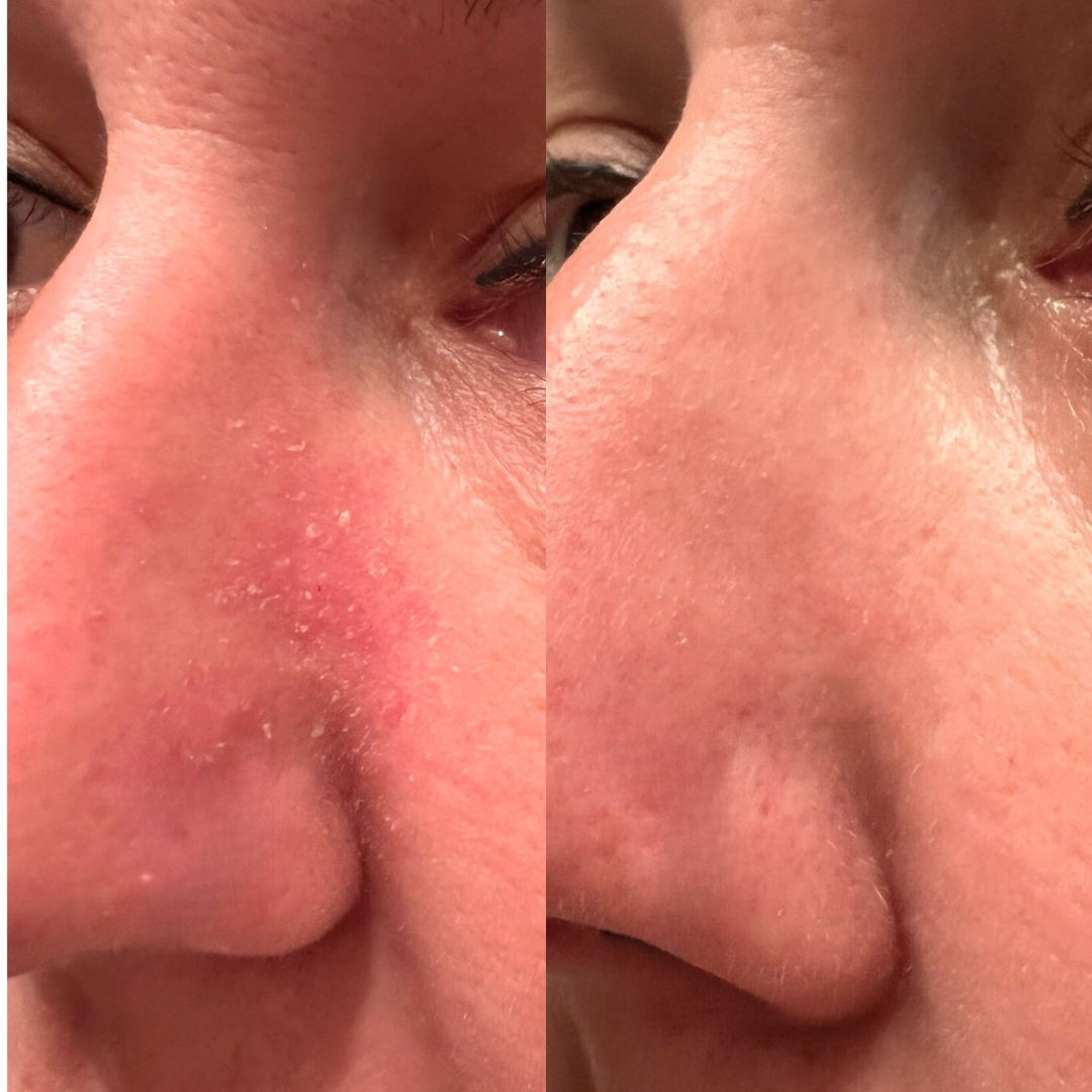 Before and after images showing improvement in facial redness and skin complexion.