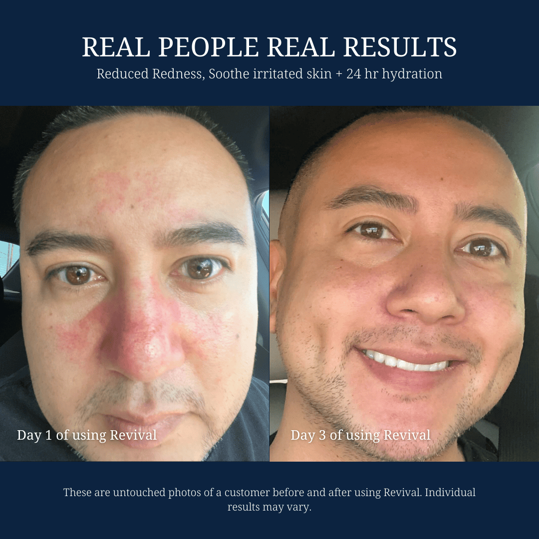 Before and after photos of a man's skin improvement using a skincare product.