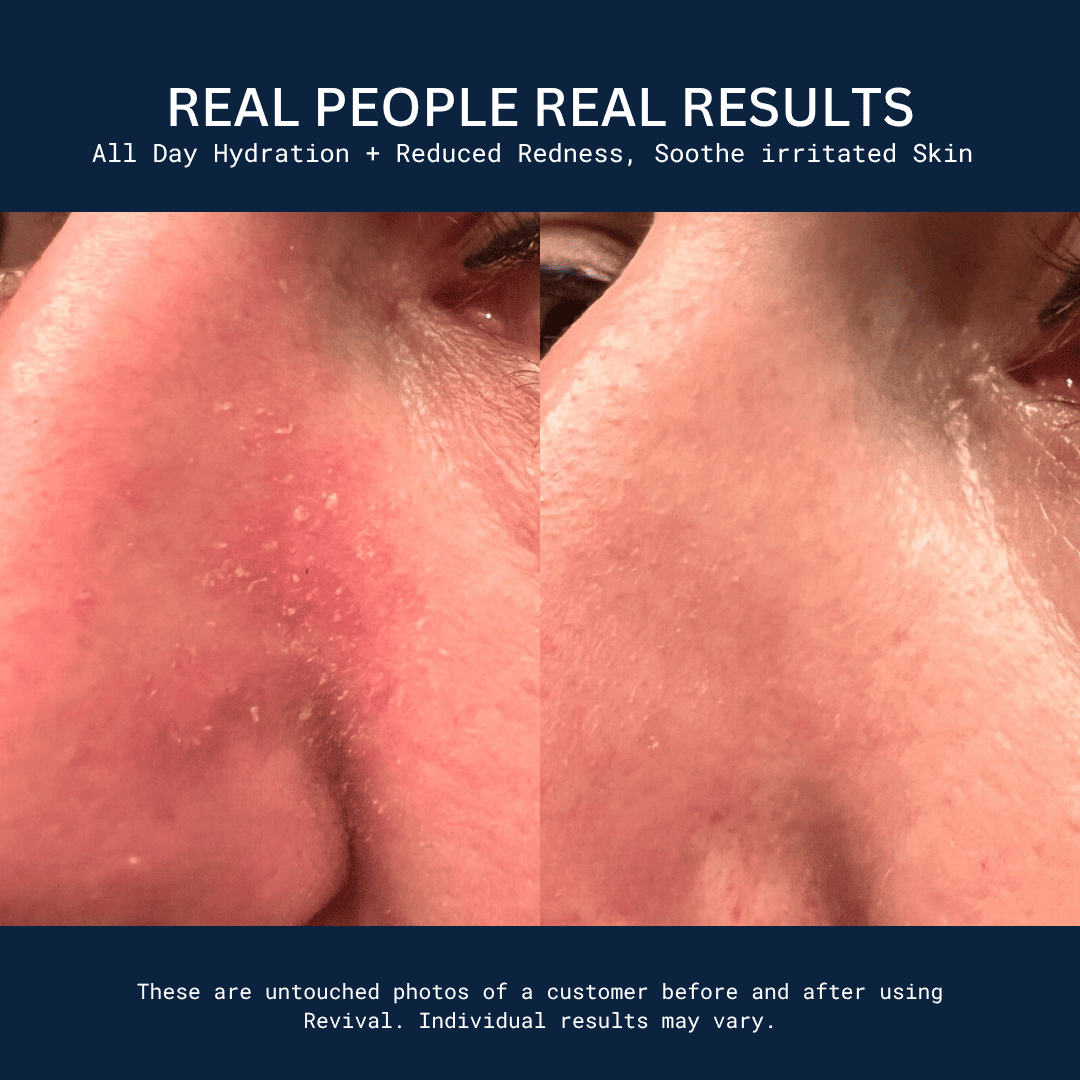 Side-by-side comparison of facial skin before and after treatment, showing reduced redness and improved texture.
