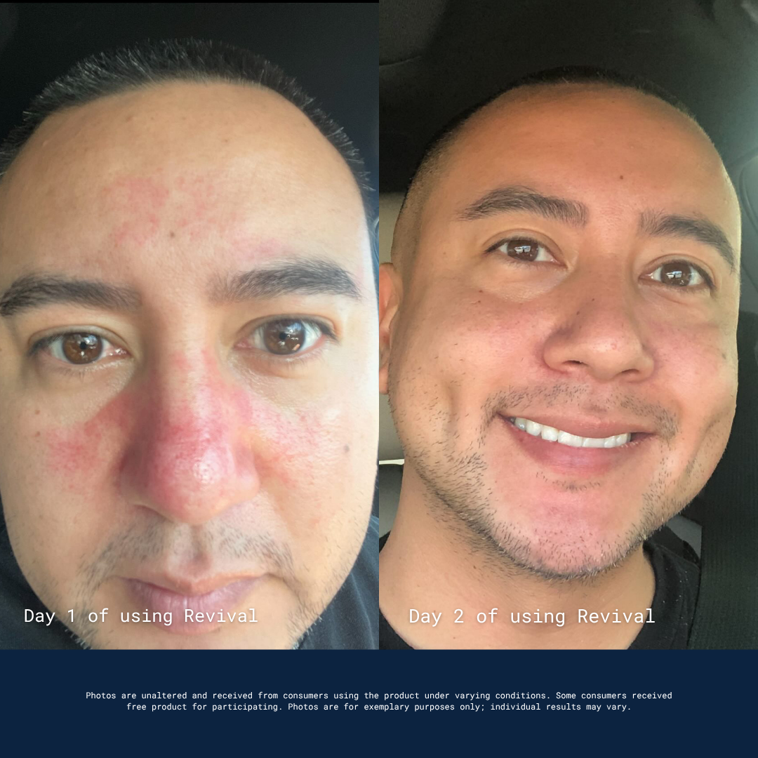 Before and after photos of a man's face showing a significant reduction in skin redness after one day.