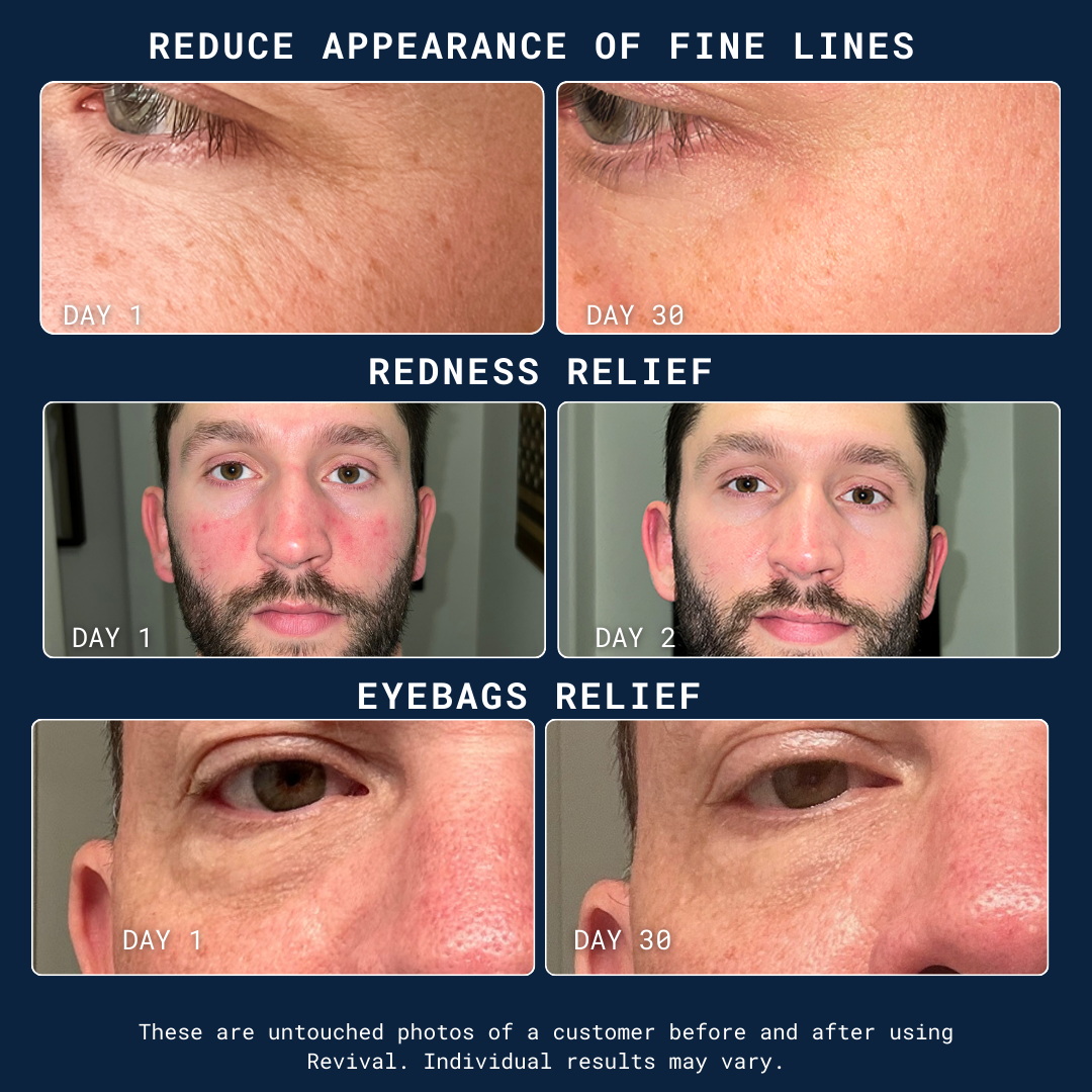 Before and after images showing reduction of fine lines, redness, and eyebags over time.