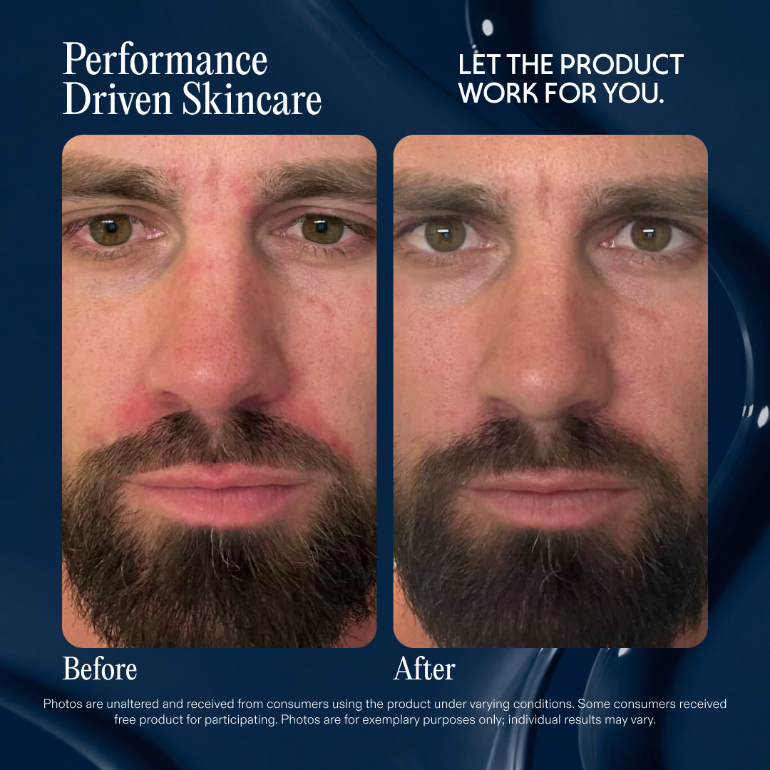 Before and after photos of a man's face, showing a visible reduction in skin redness.