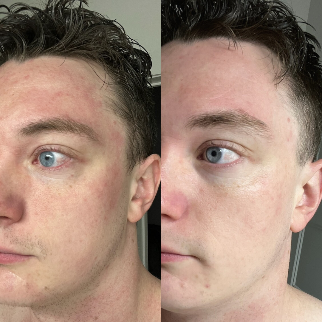 Side-by-side comparison of a man's face showing skin improvement.