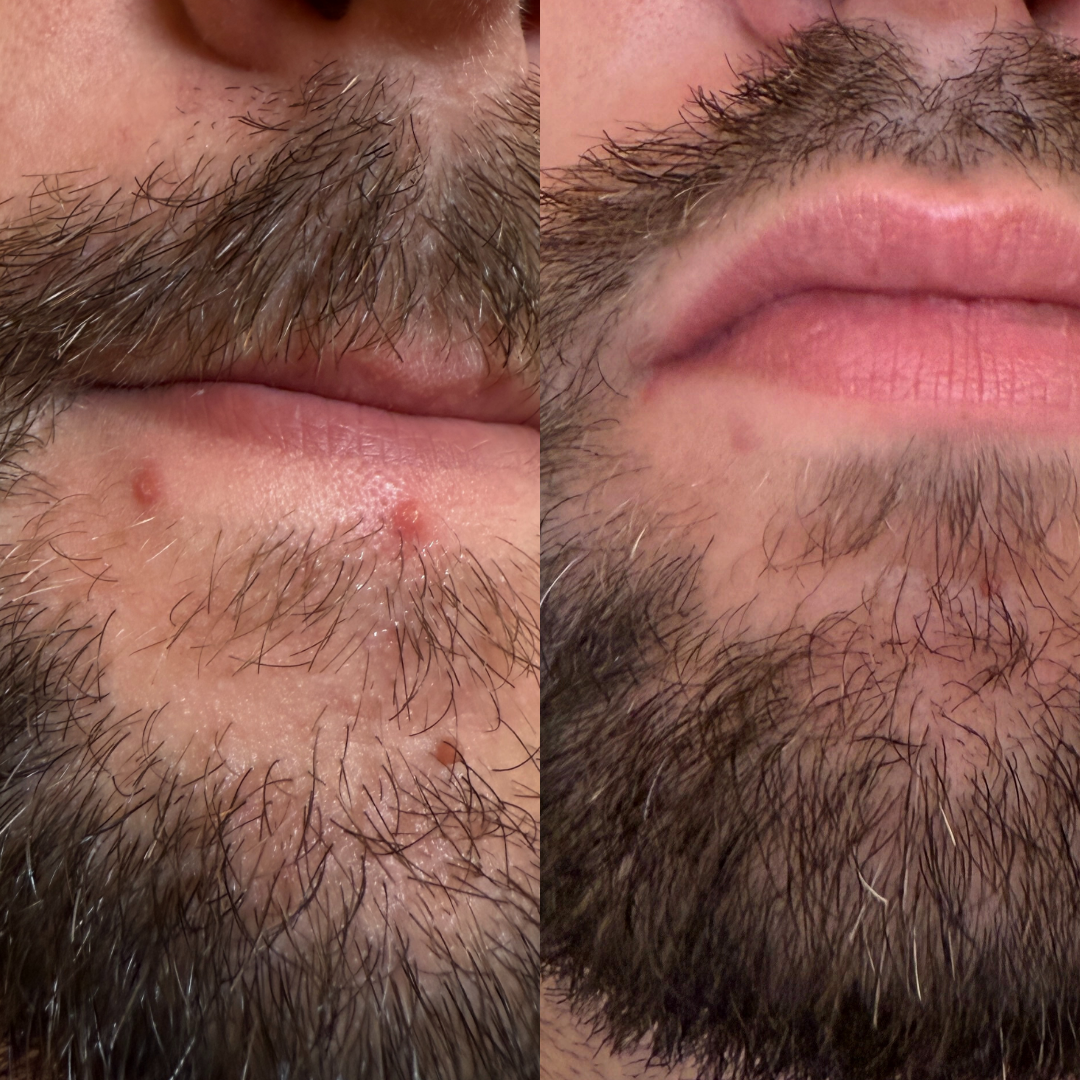 Side-by-side comparison of skin before and after treatment for wrinkles.