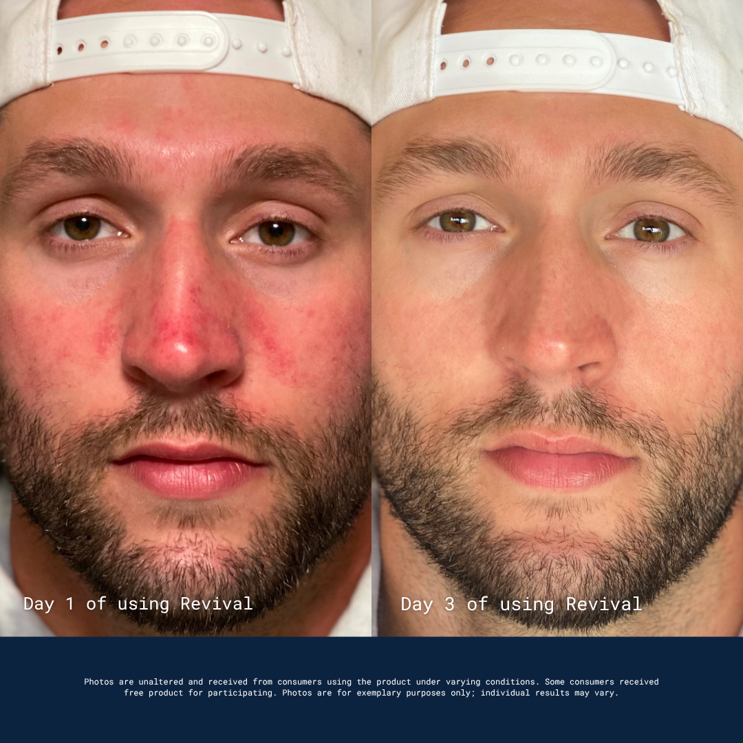 Side-by-side comparison photos of a man's face, showing a reduction in skin redness from day one to day three.