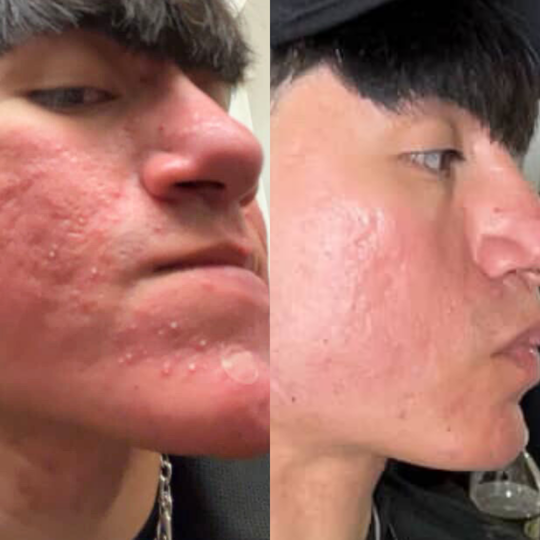 Before and after images showing reduced under-eye puffiness.
