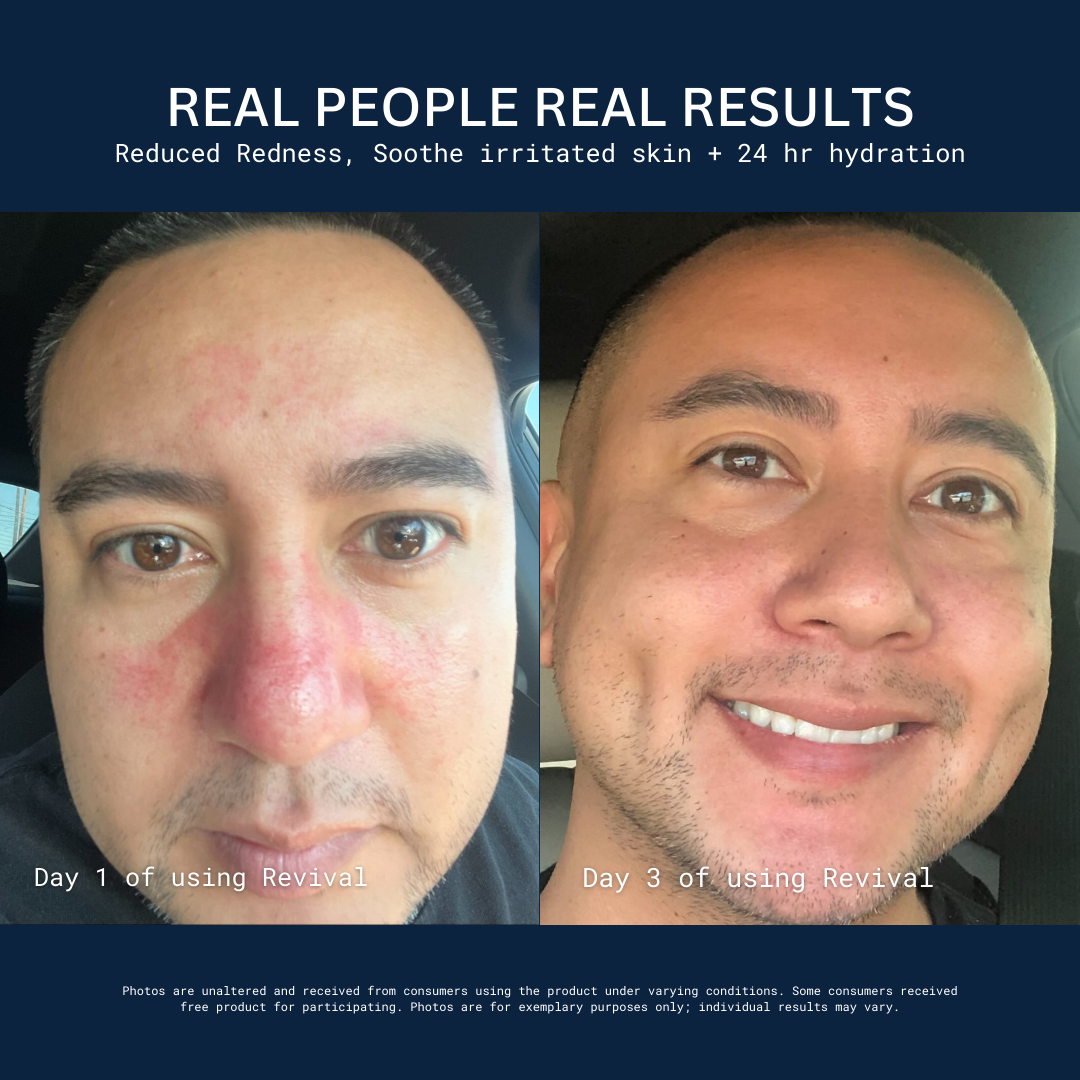 Before and after close-up photos of a man's face showing reduced redness.