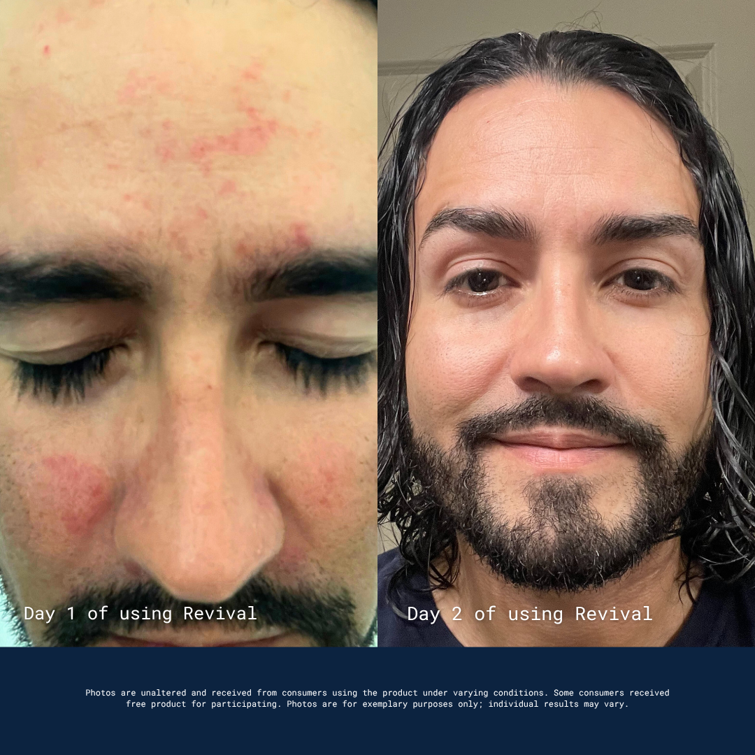 A before and after image of a man's face, showing reduced skin redness and irritation from day one to day two.