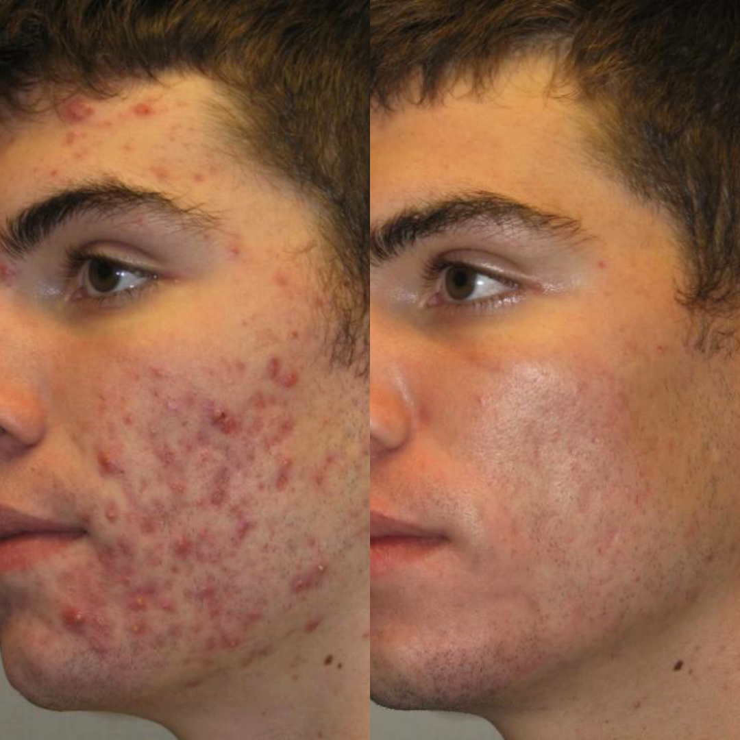 Before and after comparison showing skin improvement on a man's face.