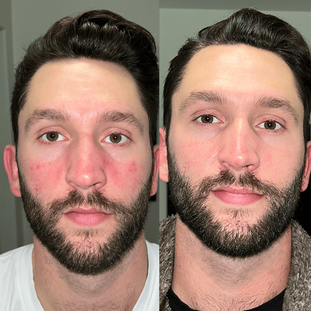 Side-by-side comparison of a man's face with and without facial redness.