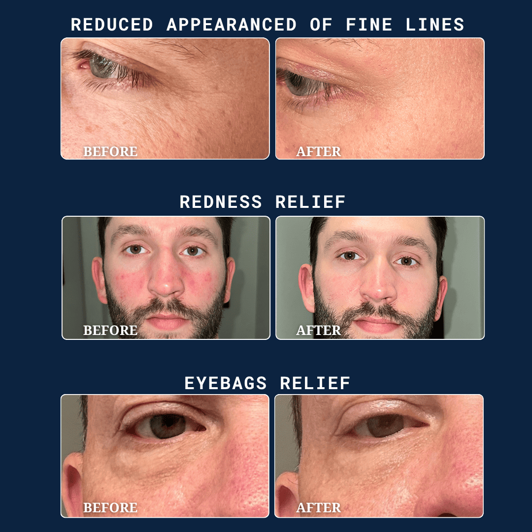 Before and after images showing reduced fine lines, redness, and eyebags.
