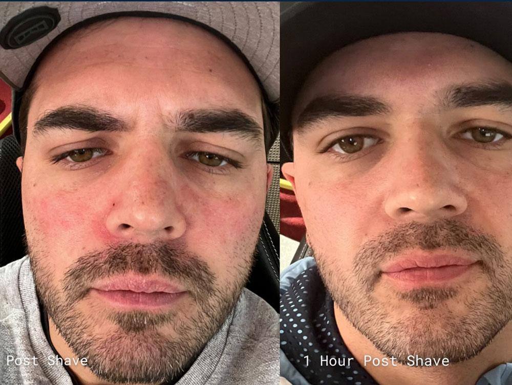 Side-by-side comparison of a nose with and without skin redness.