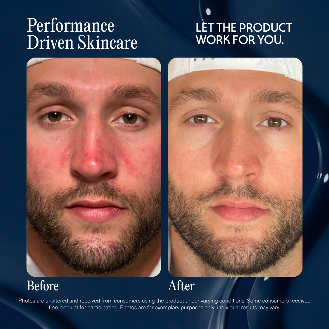 Before and after photos of a man's face, showing a significant reduction in skin redness and irritation.