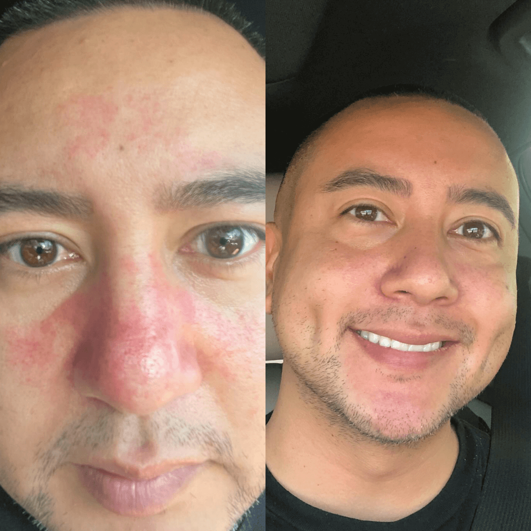 Side-by-side comparison of a man's face with and without facial redness.