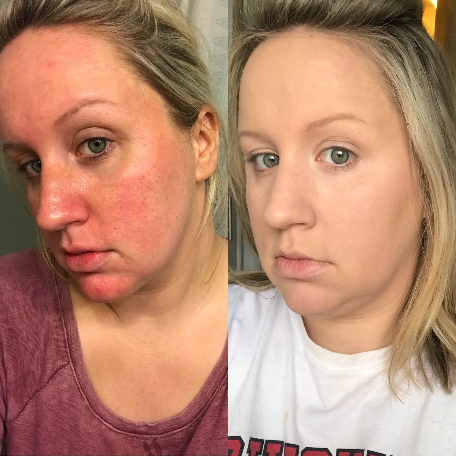 A side-by-side image of a woman's face, showing red and blotchy skin on the left and clear skin on the right.
