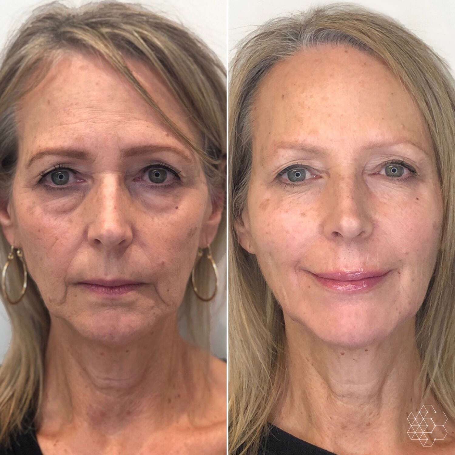 A side-by-side before and after image of a woman's face, showing a reduction in wrinkles.