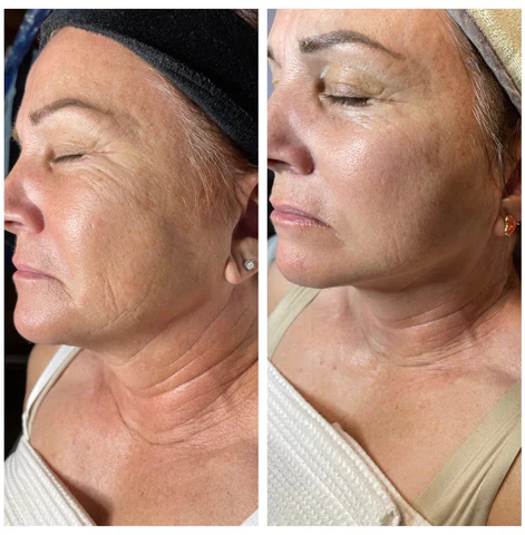 A before-and-after comparison of a woman's face and neck, showing a reduction in wrinkles.