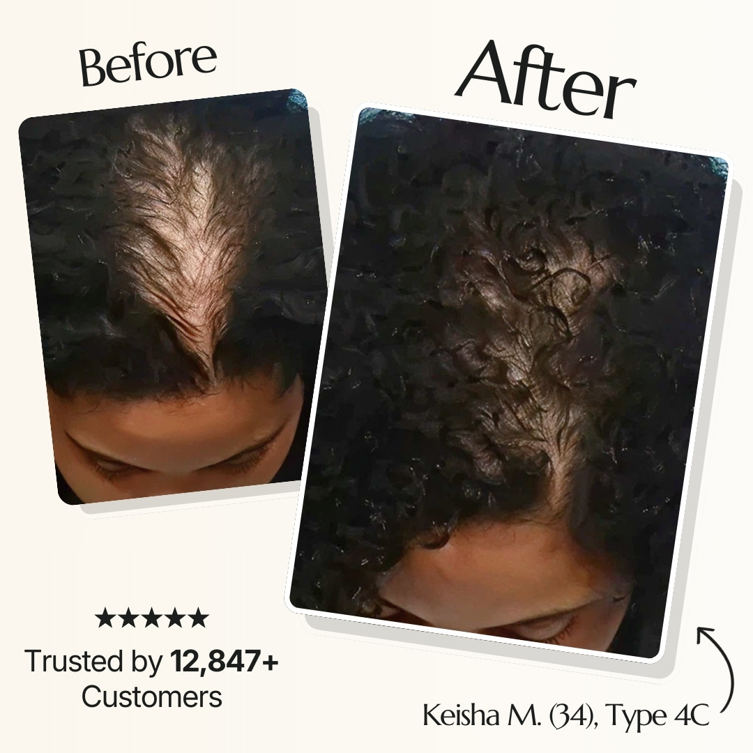 Before and after photos showing significant hair regrowth and thickness on a person's scalp.