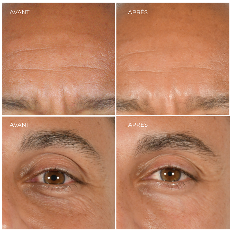 Before and after images showing forehead and eye area.