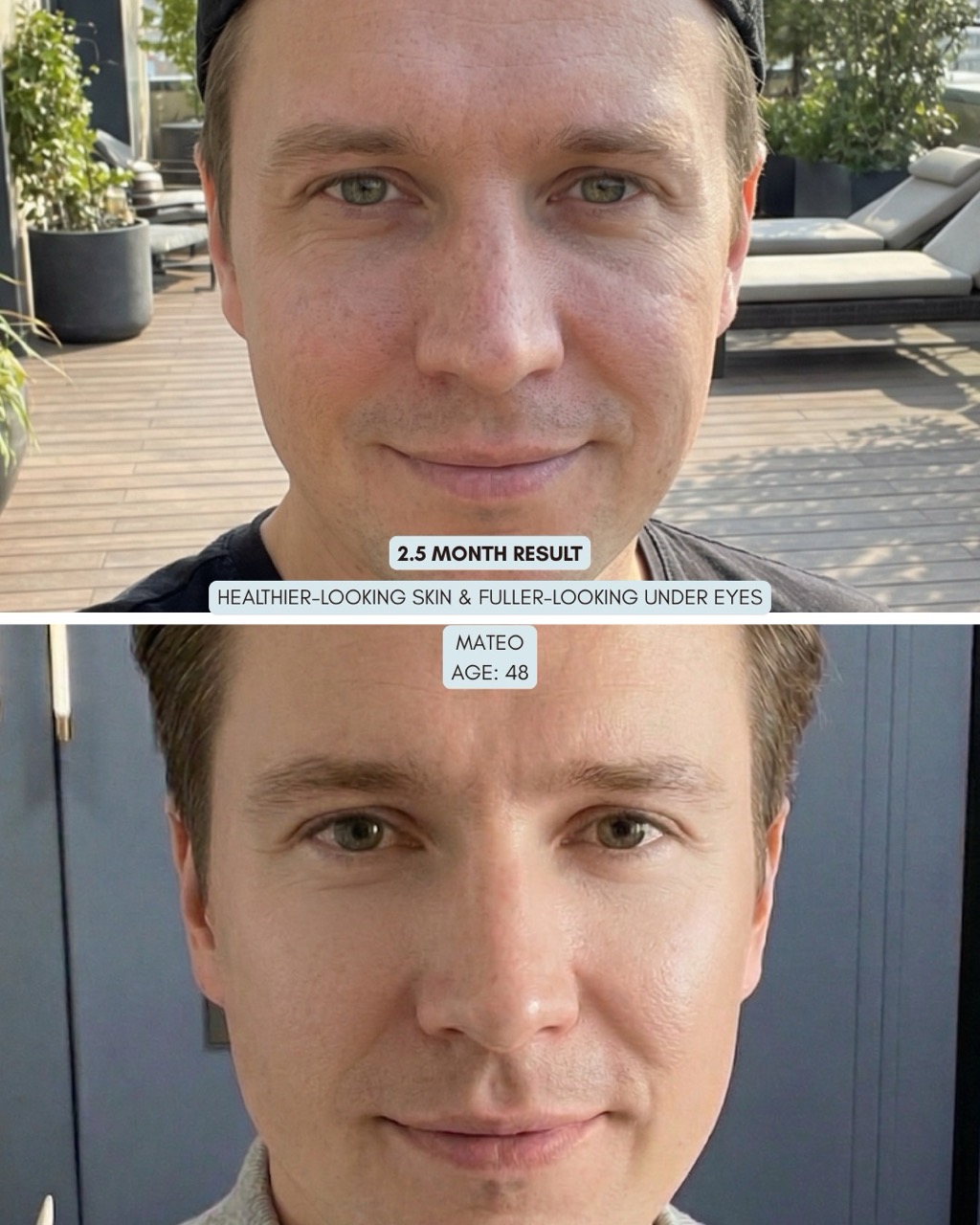 Before-and-after photos of a man's face showing skincare results over 2.5 months, with smoother, fuller under-eyes.
