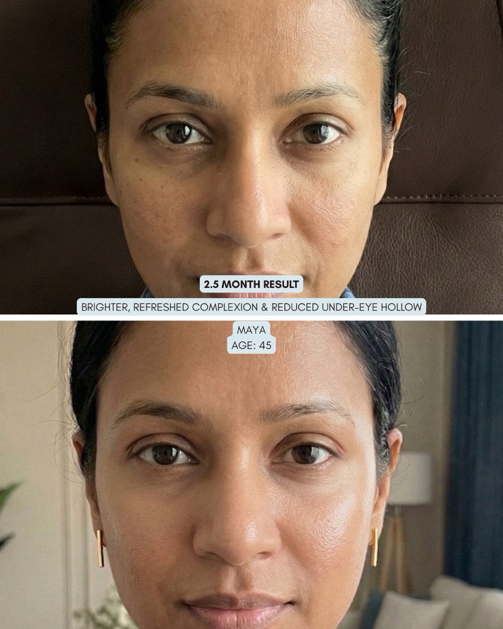A before and after image of a woman's face showing improved skin tone and reduced under-eye hollows.