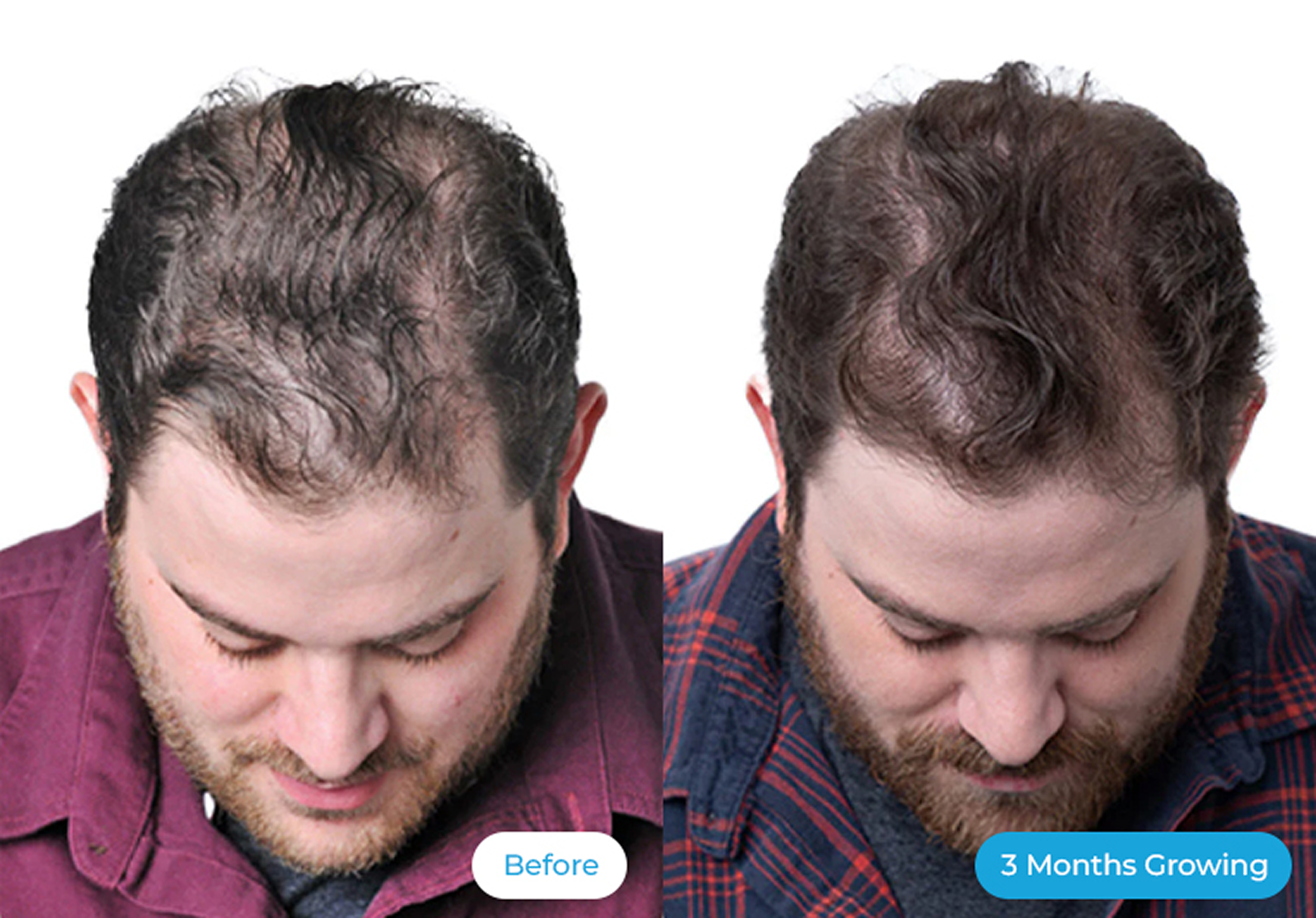 Two side-by-side images showing hair growth over three months.