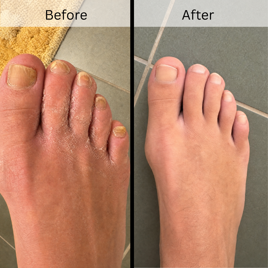 A before-and-after image showing a foot with unhealthy, peeling skin and yellow nails next to a healthy foot.