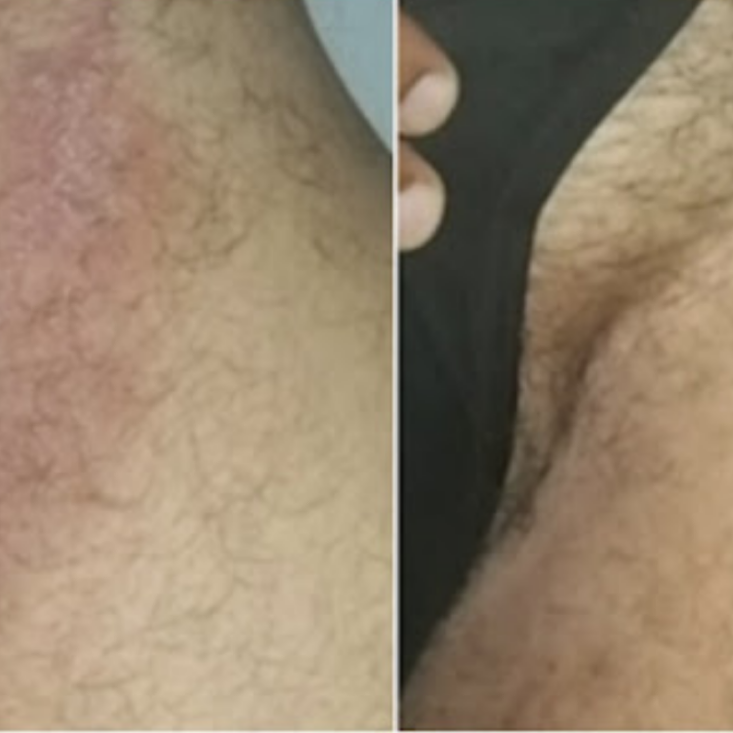 A split-screen, before-and-after image showing a red skin rash on the left and clear skin on the right.