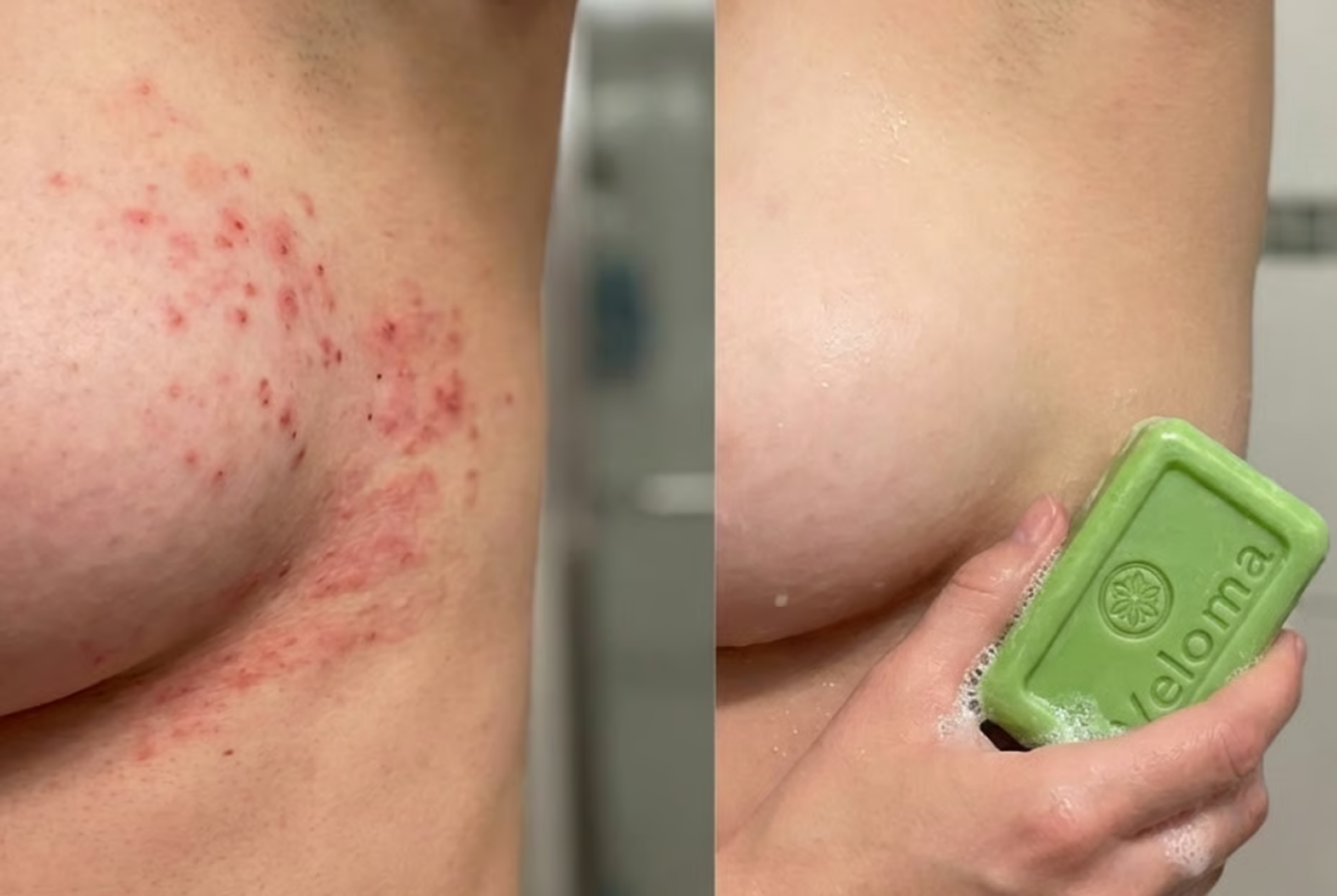 A before-and-after image showing a rash under a breast, and clear skin being washed with a green soap bar.