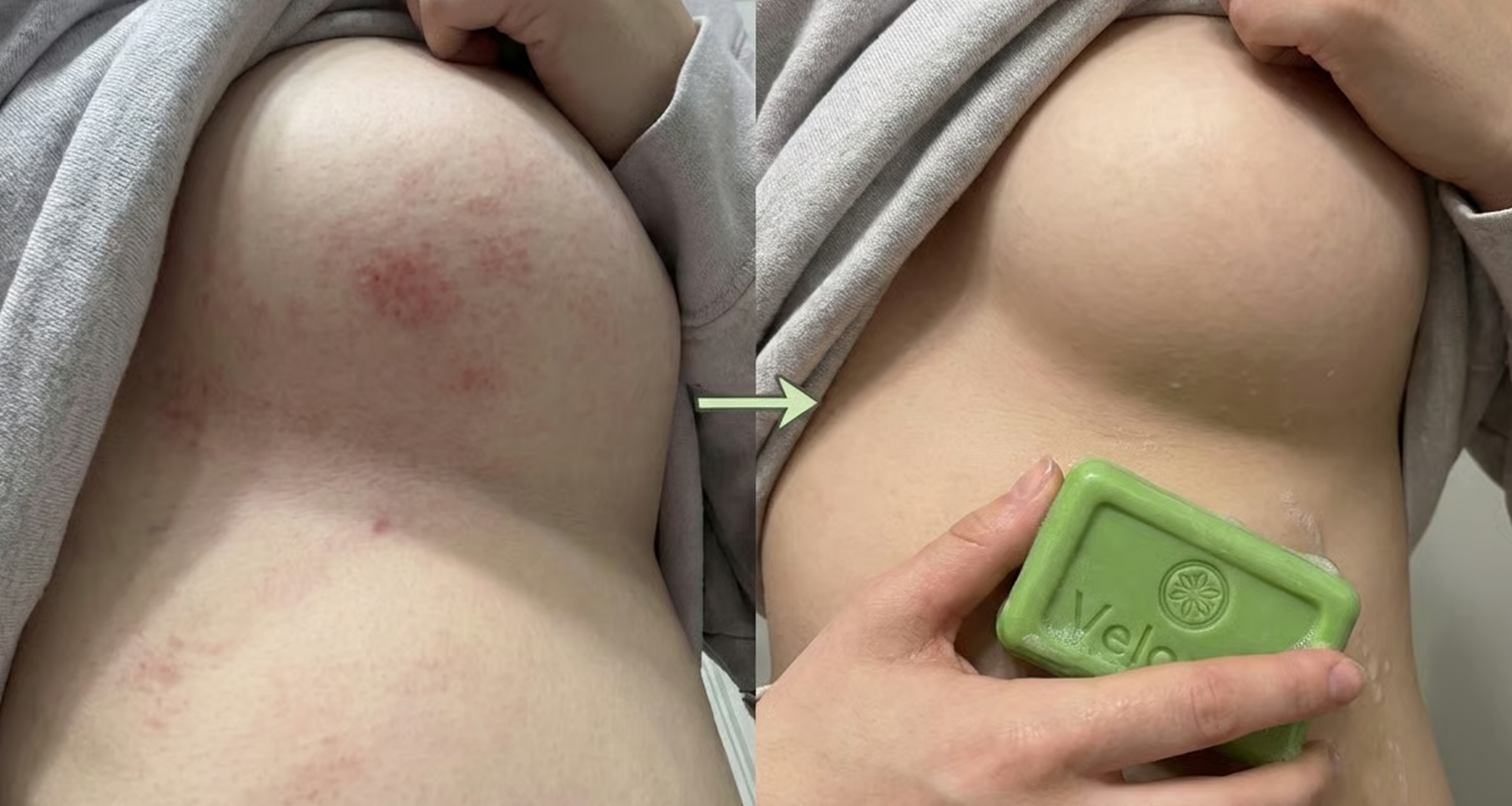 A before-and-after image showing skin with a red rash, and then clear skin with a green soap bar.