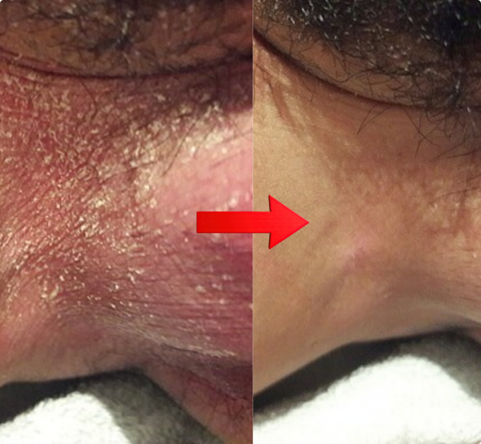 A before-and-after comparison showing skin changing from red and flaky to smooth and clear.