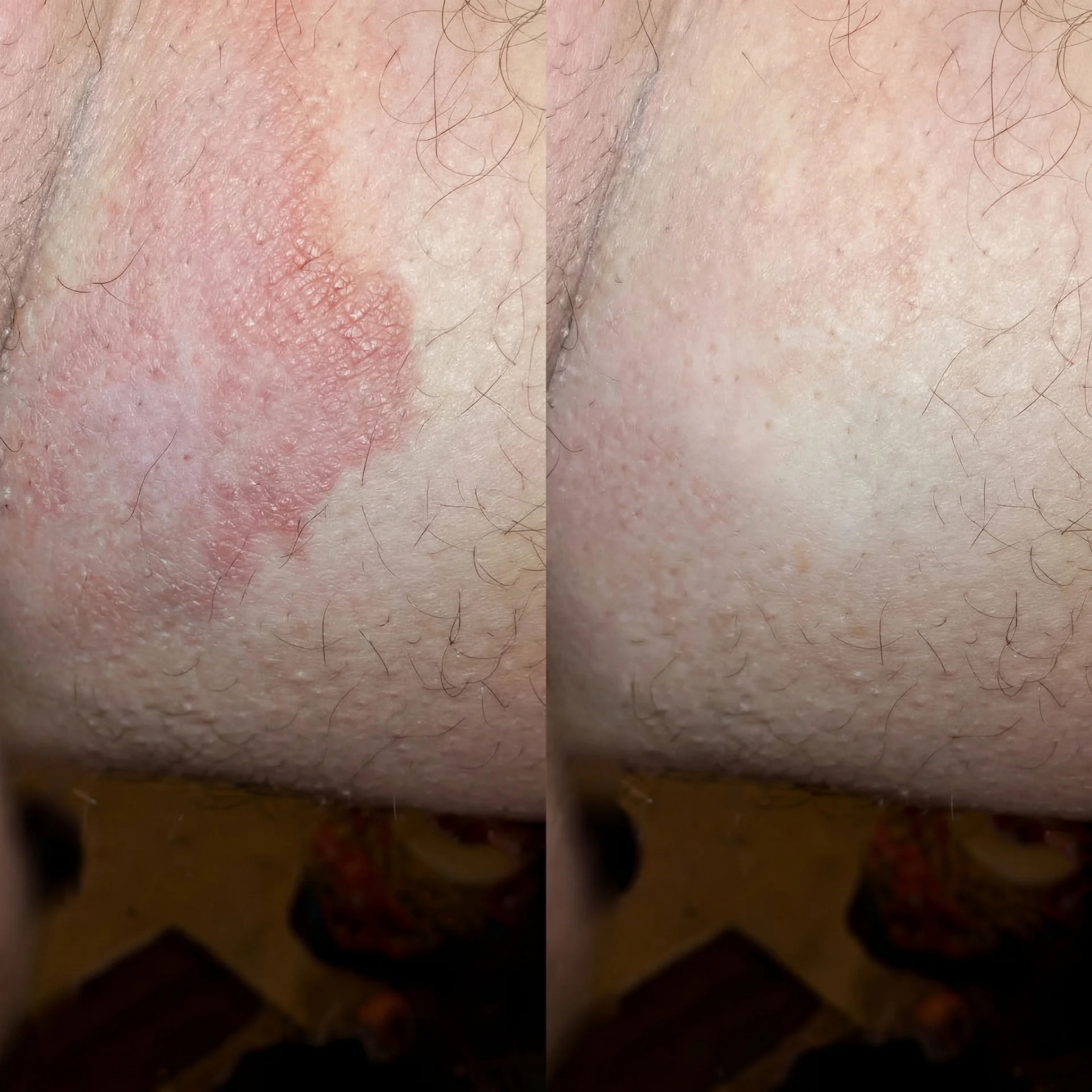 A split image showing a red, scaly skin rash on the left and the same area mostly healed on the right.