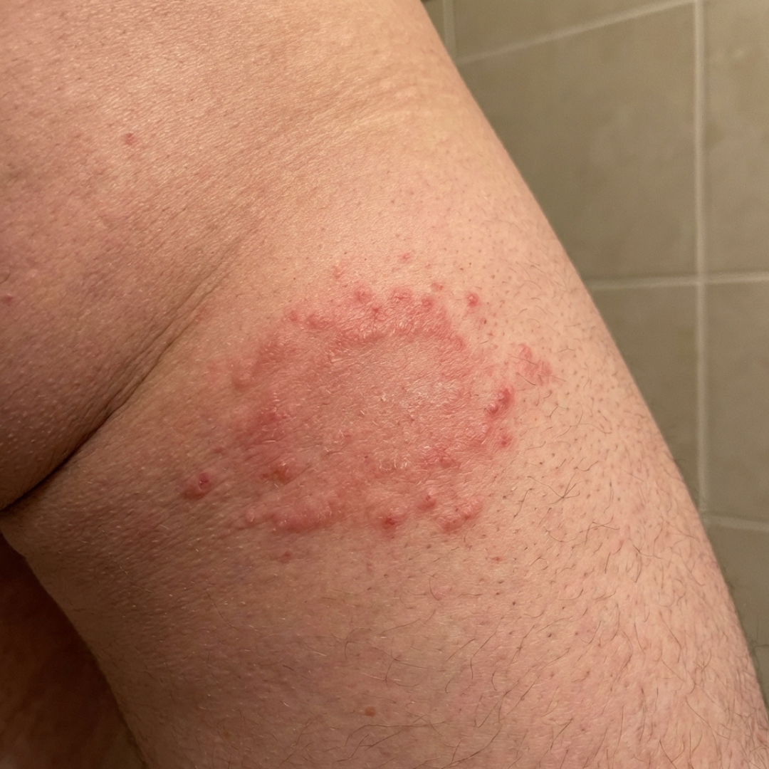 A close-up of a circular, red, inflamed rash on a person's skin.