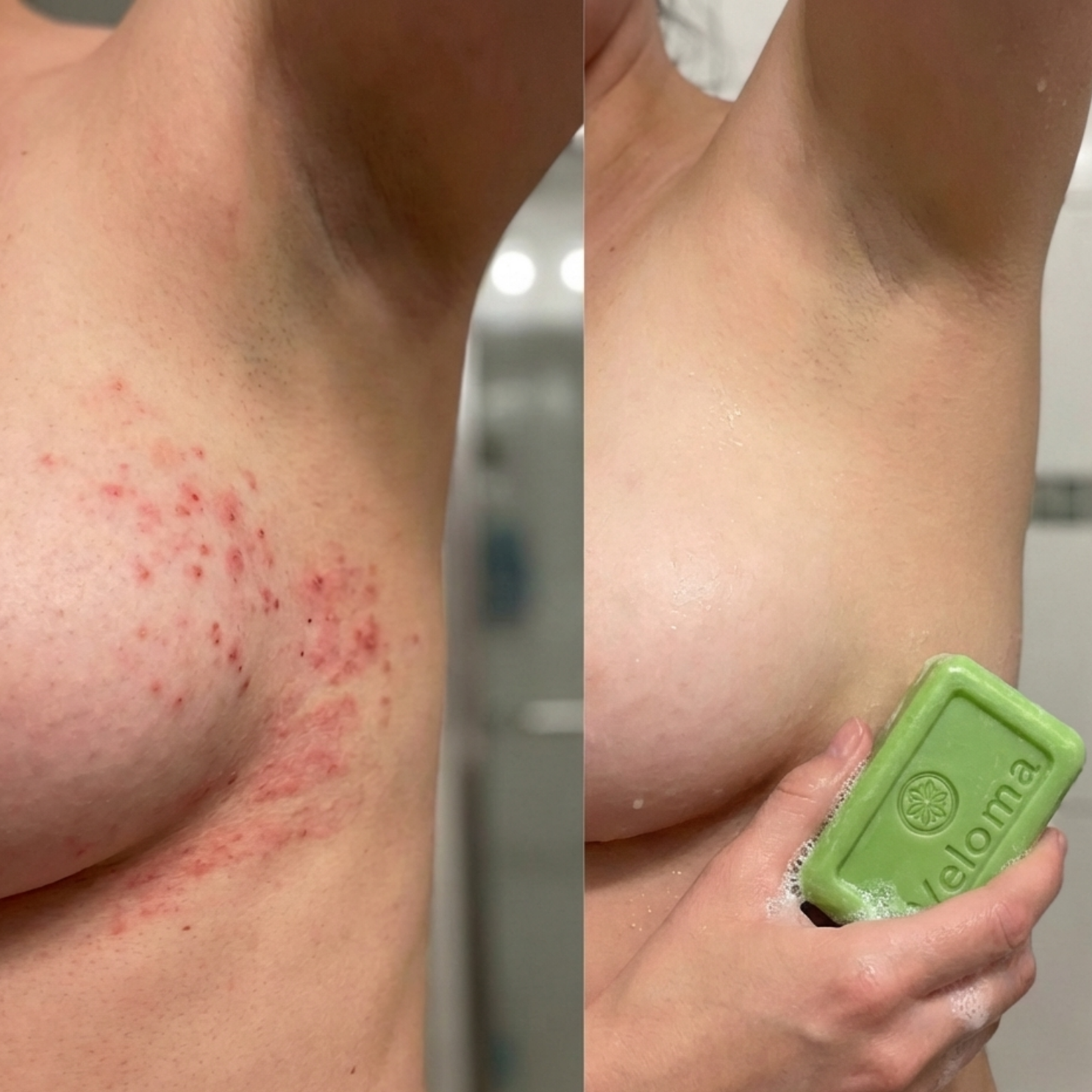 A before-and-after image shows a rash on a person's breast and underarm, then clear skin and soap.