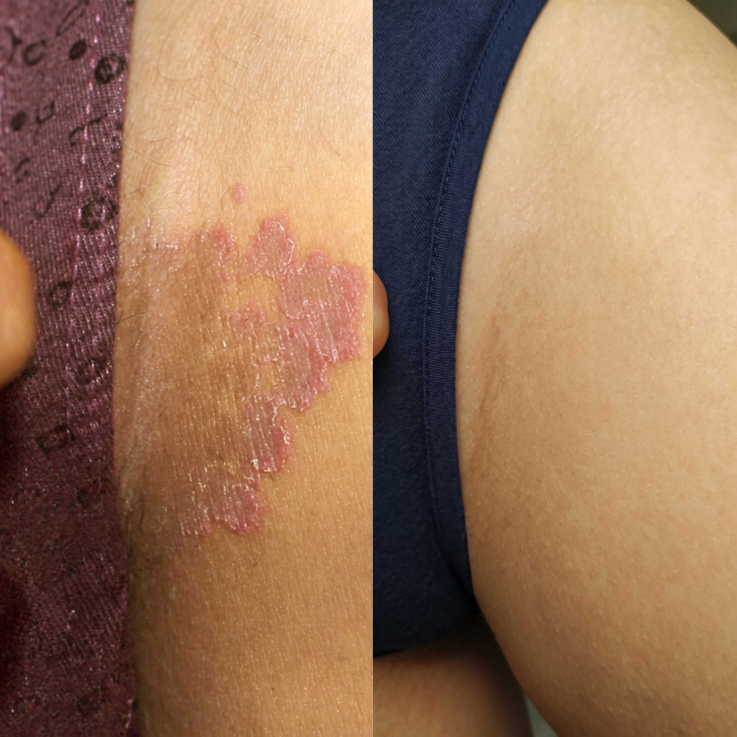 A split-screen image showing a red, scaly skin patch before and after healing on the right.
