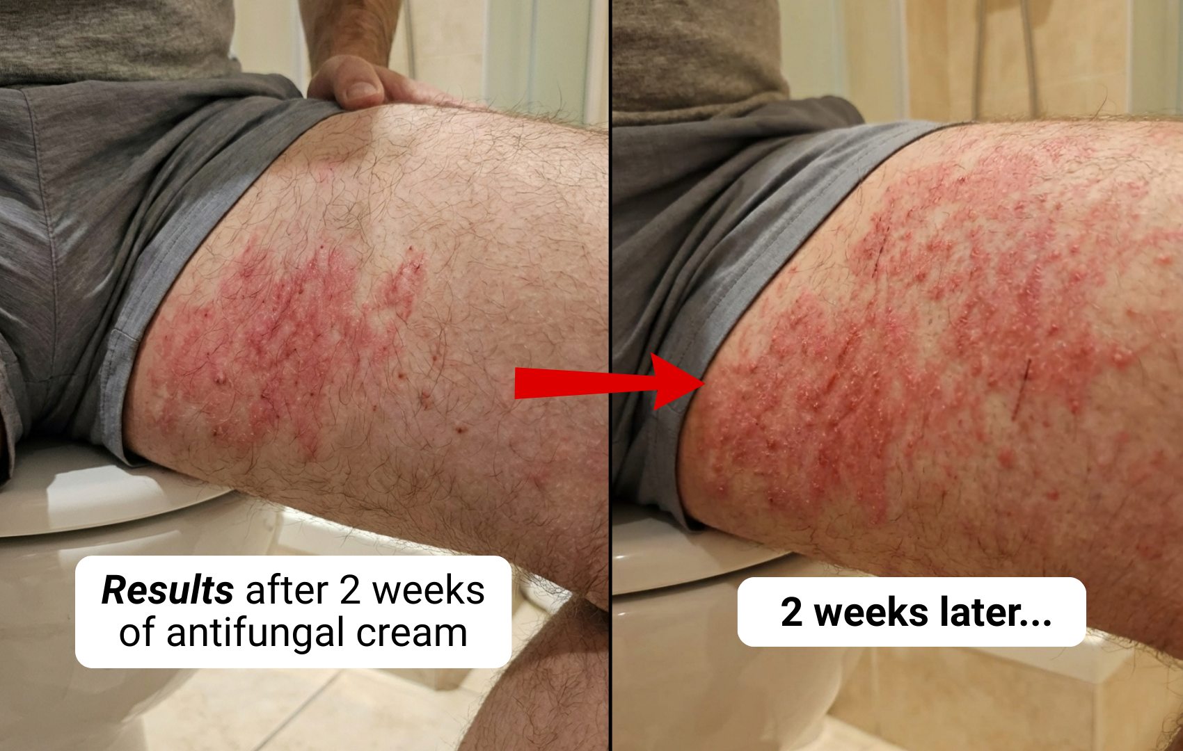 A before and after image showing a severe red skin rash on a person's upper thigh getting worse.