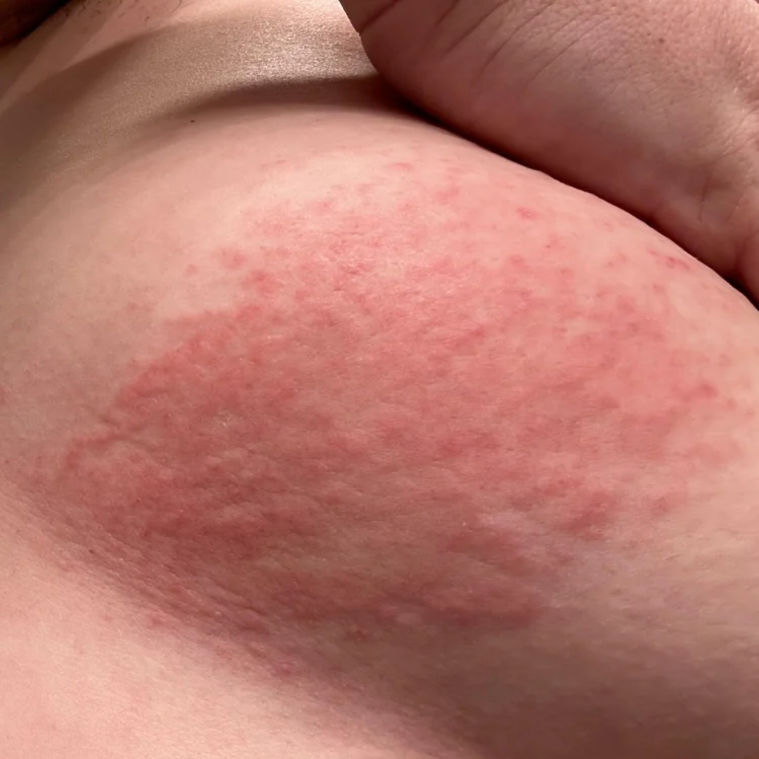 A close-up of a red, bumpy rash on a person's skin.