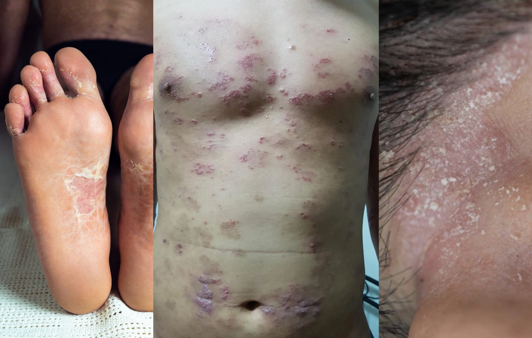 A collage showing scaly, red, and peeling skin on a person's feet, torso, and scalp.