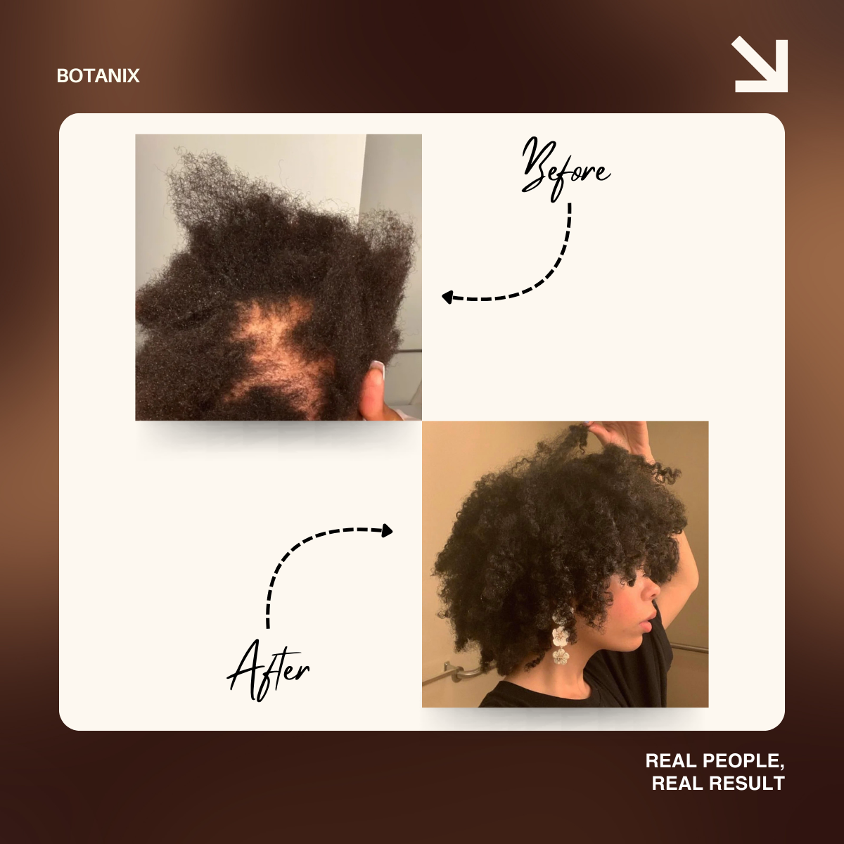 A before and after comparison showing significant hair regrowth on a person's scalp with dark, curly hair.