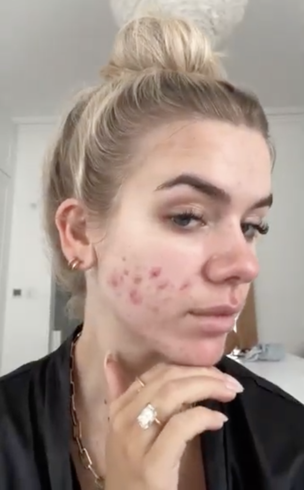 A close-up of a woman with blonde hair tied in a bun, showing acne on her cheek.