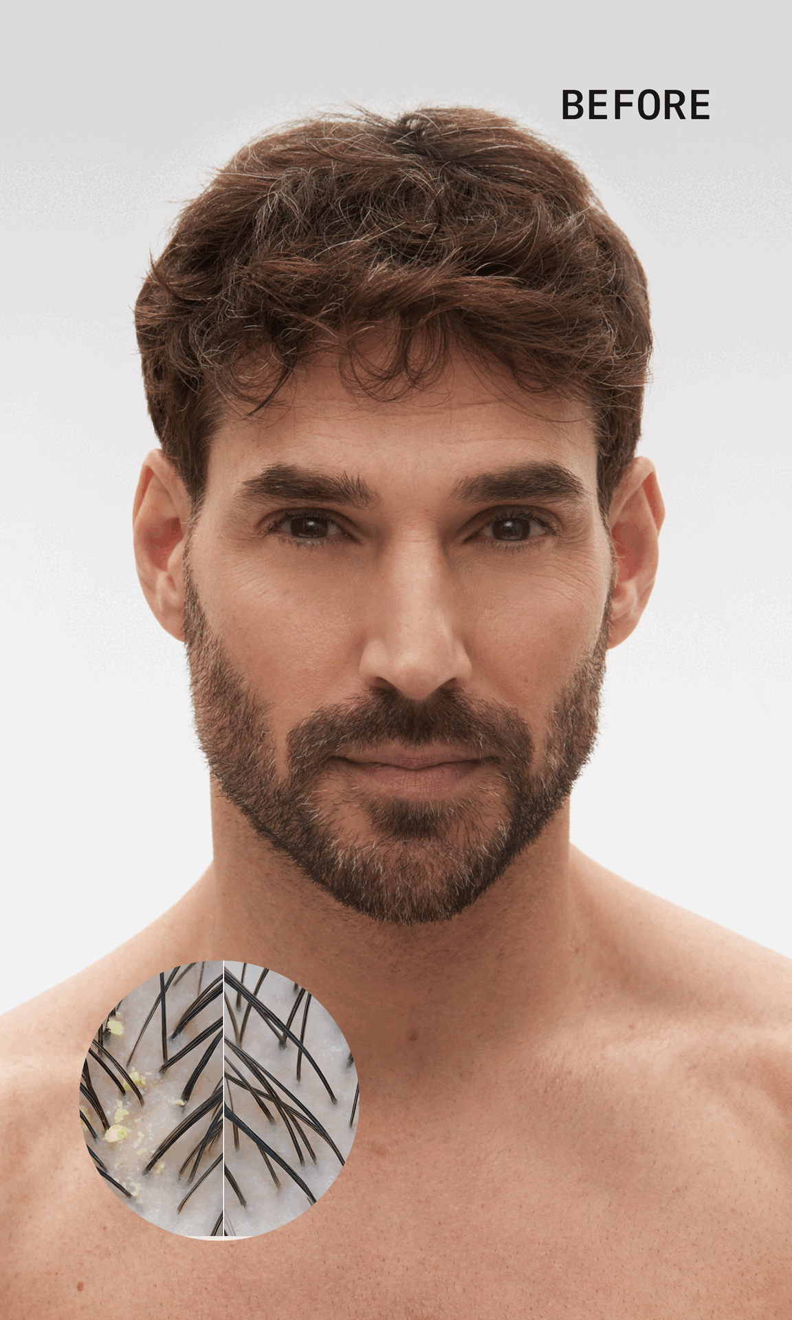 Man with beard, close-up of scalp with dandruff, text 'BEFORE'.
