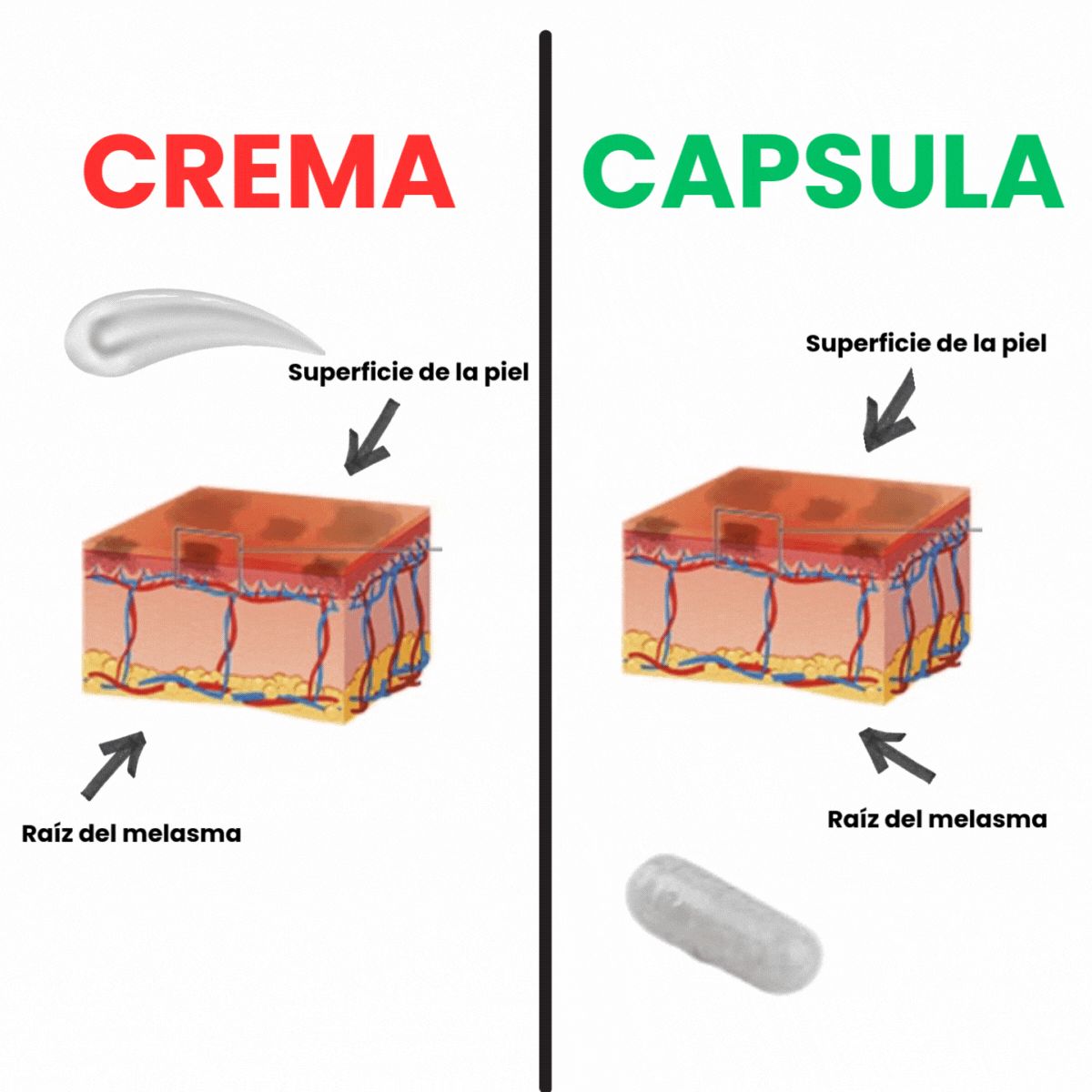 Diagram comparing skin effects of cream and capsule on melasma roots.