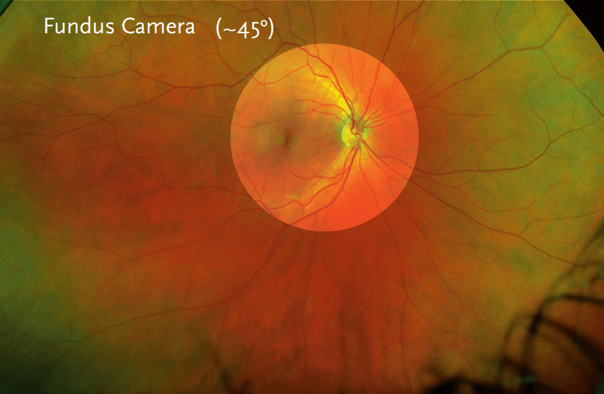 Close-up image of a human retina with visible blood vessels.